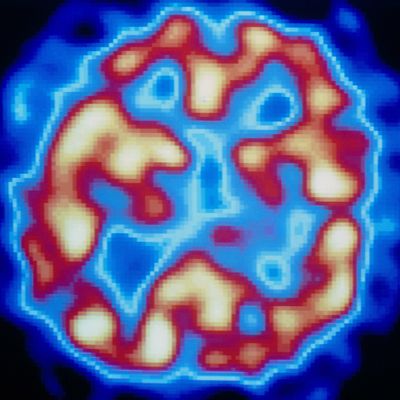 PET scan (temporal) of hallucinating schizophrenic