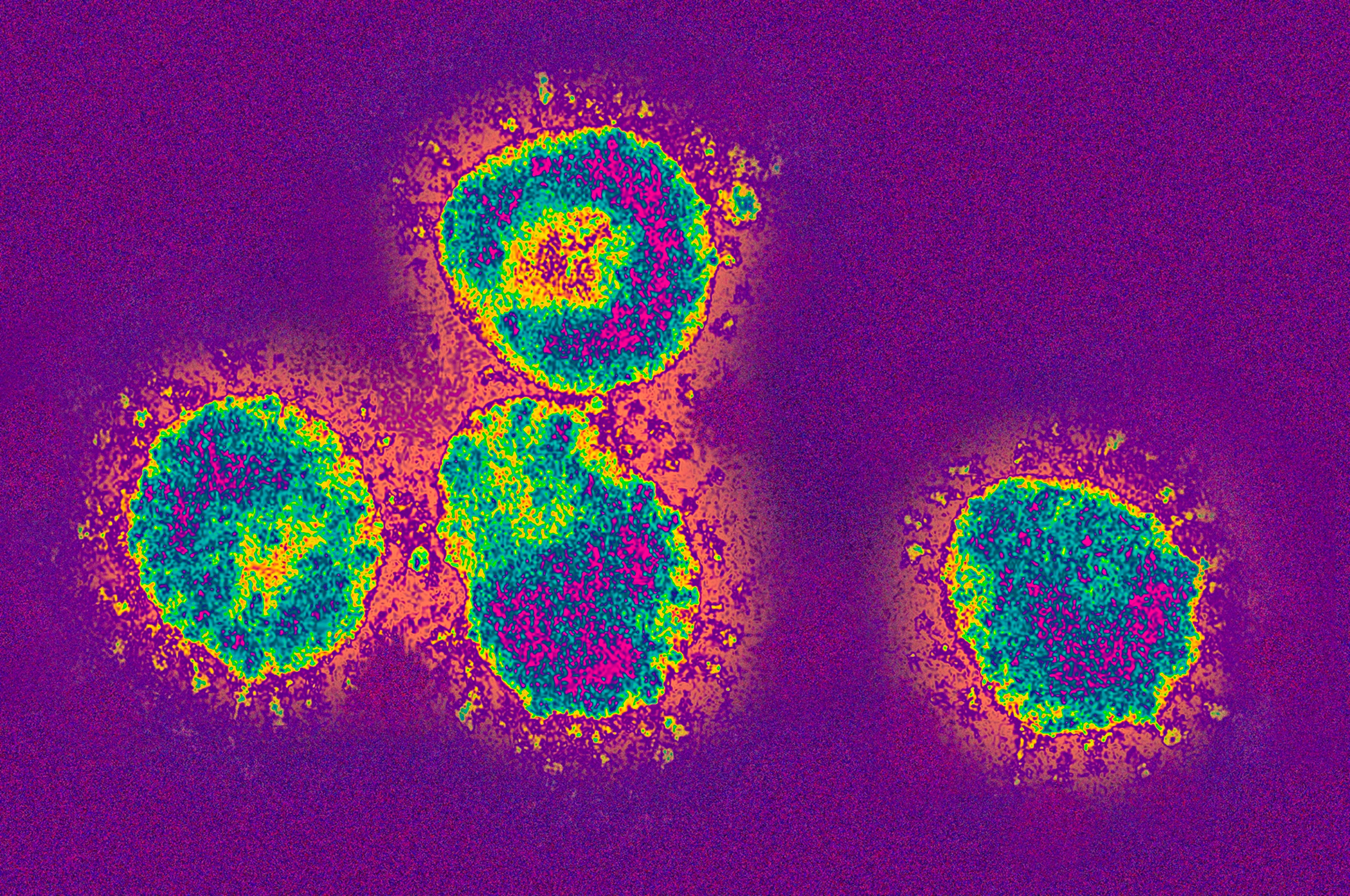 Коронавирус. Вирус коронавирус. Вирусы под микроскопом. Вирусная пневмония под микроскопом.