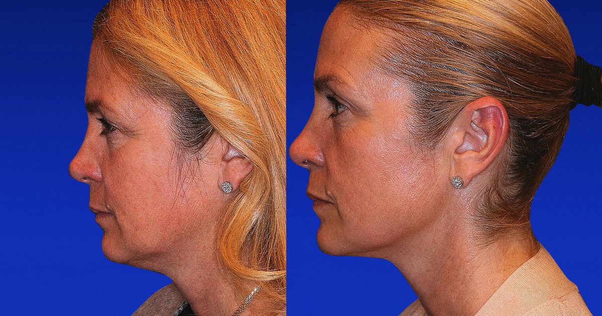 I Got Ultherapy Instead of a Face-lift