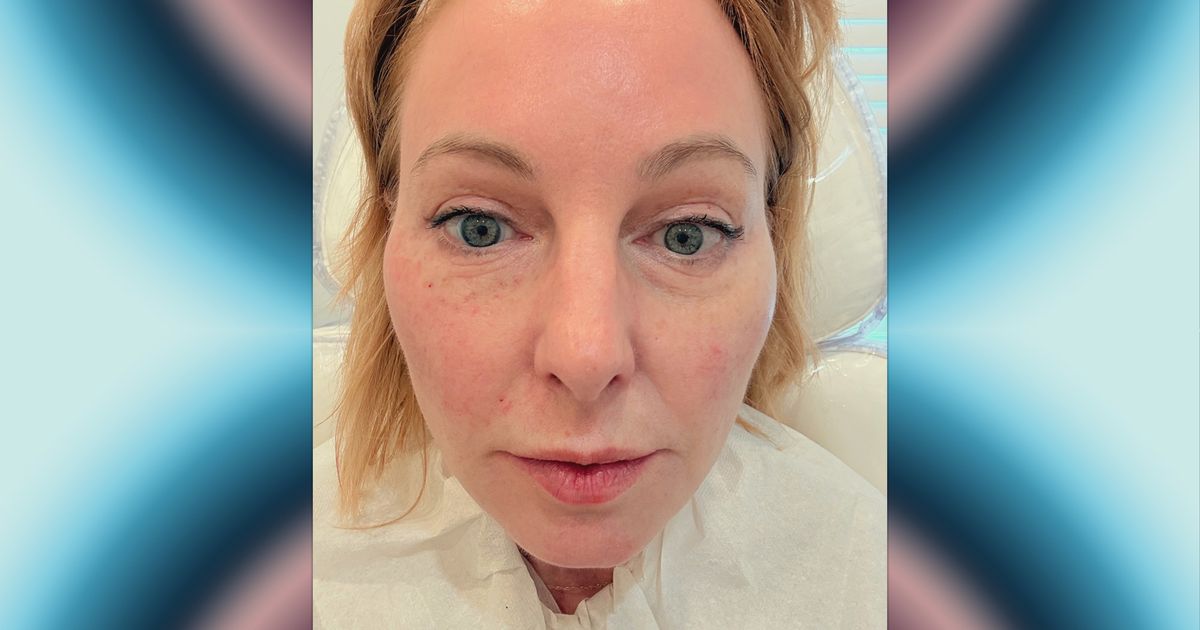 I Tried the New Vampire Facial