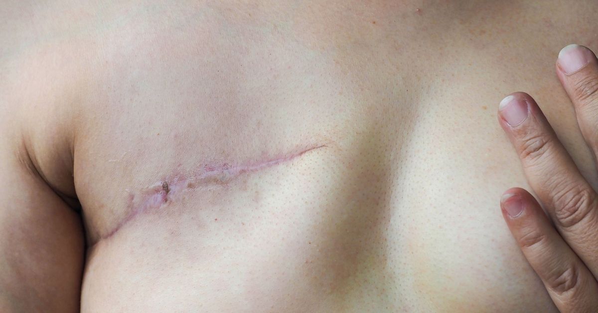 How Far Would You Go for a Breast?