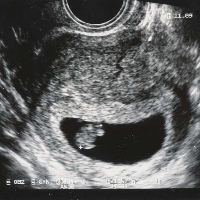 Why 'Fetal Heartbeat Bill' is a Misleading Phrase