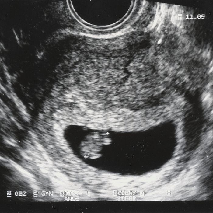 should there be a heartbeat at 7 weeks