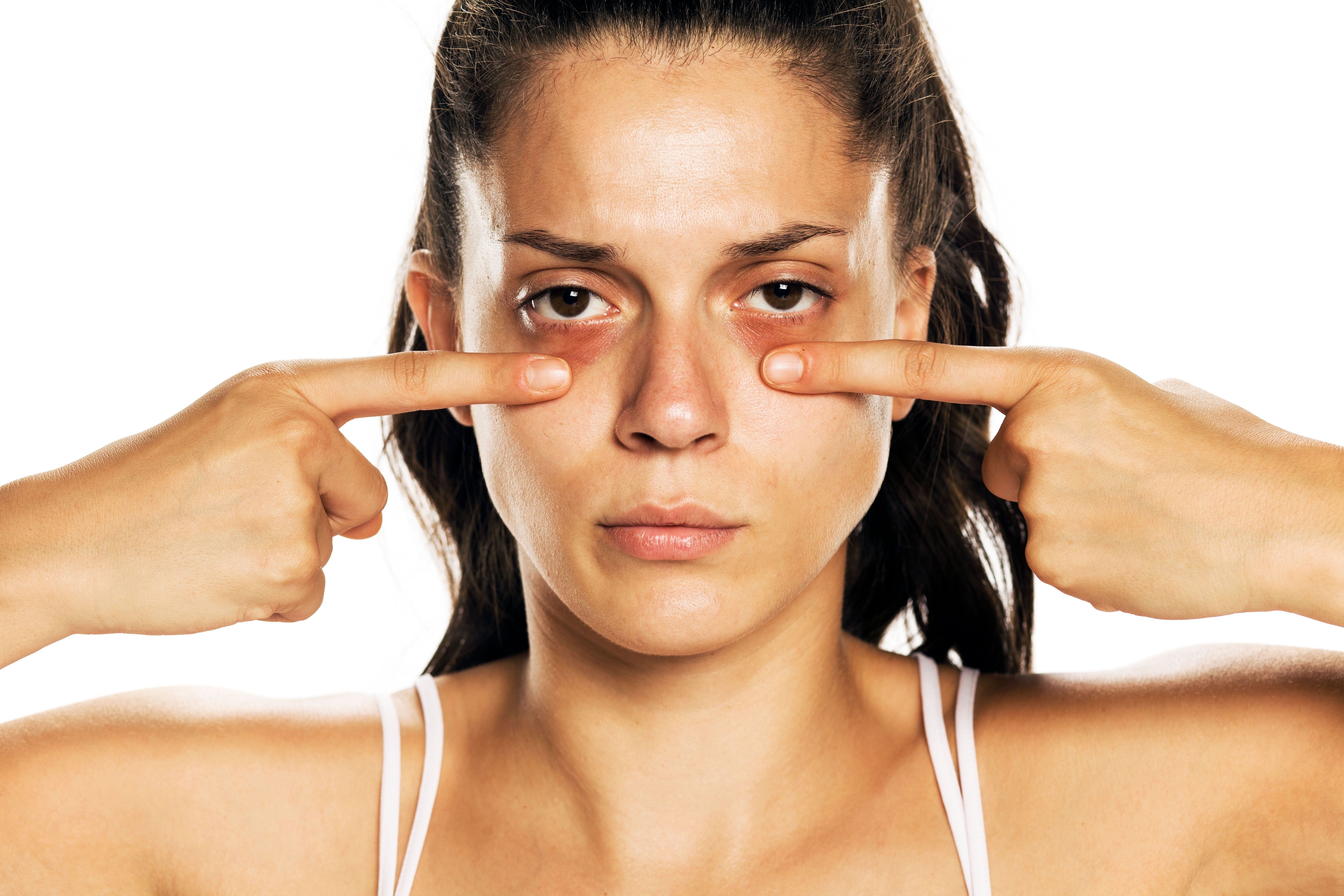 Puffy Eyes, Dark Circles, and Bags: Dermatologists Explain the Difference |  SELF