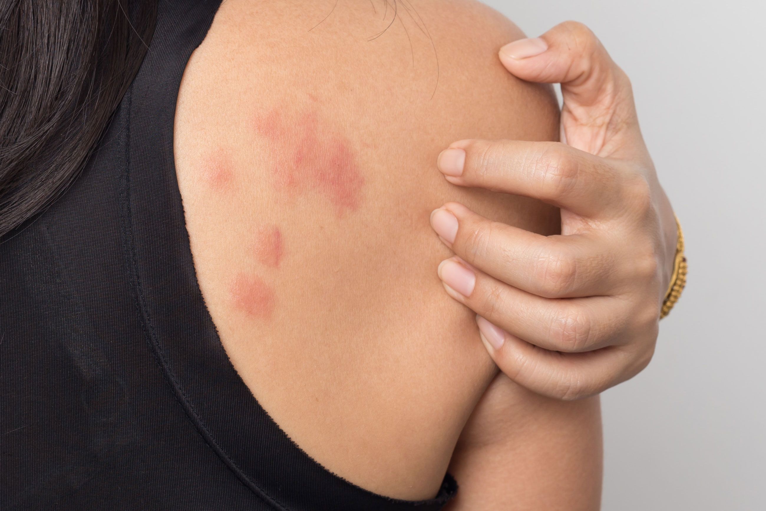 Can Hives Spread By Scratching