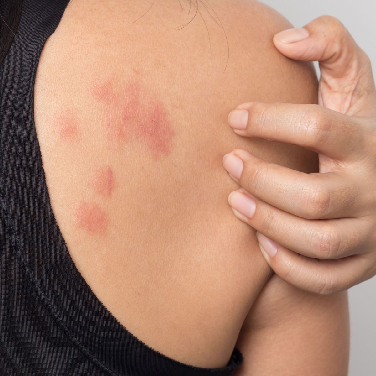 Stress Hives Causes Treatment And More