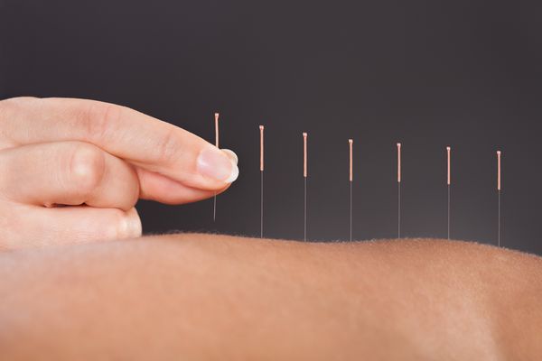 Acupuncture with Kelly Duigan