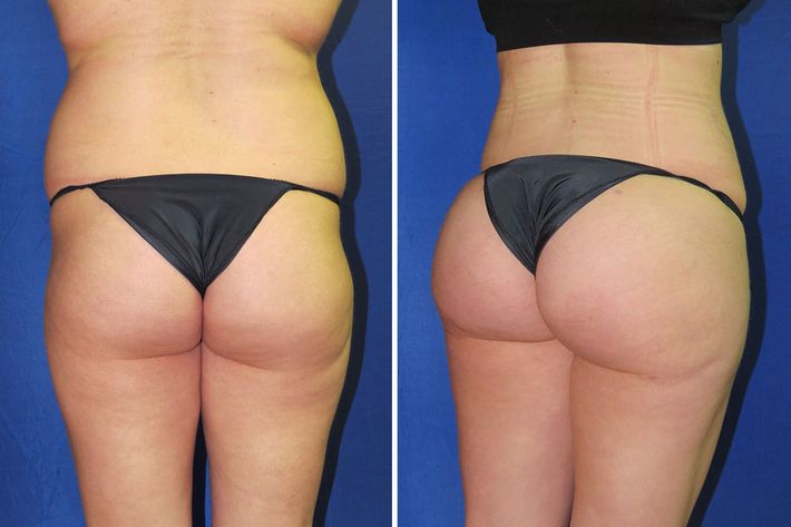 How Do Bum Implants and Brazilian Butt Lifts Work?