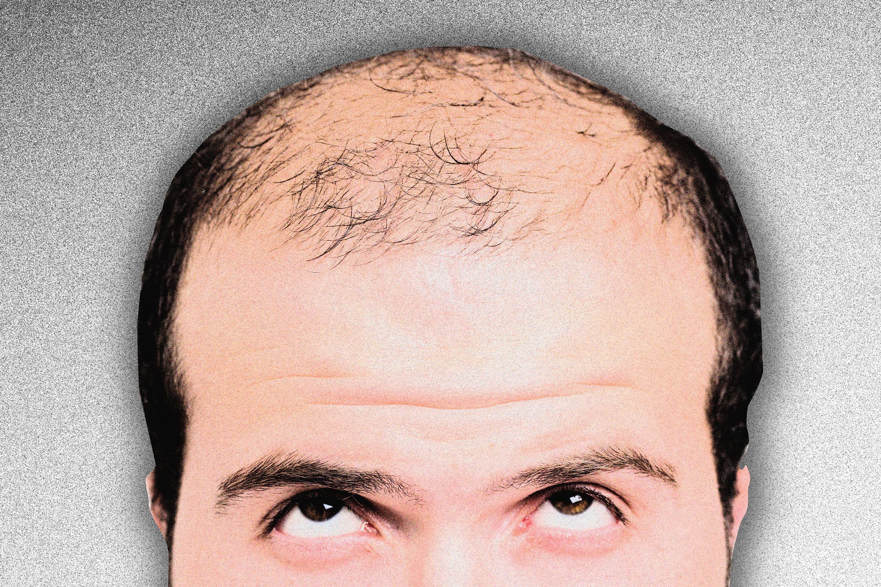 Is Minoxidil Really a Miracle Cure for Baldness?
