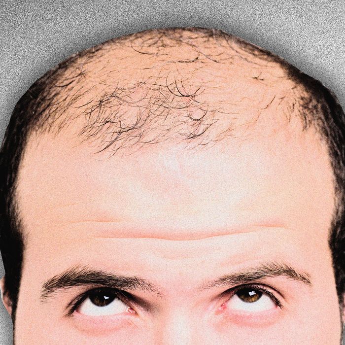 Is Minoxidil Really Miracle Cure Baldness?