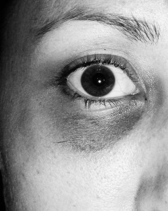 Colbie Holderness's black eye.