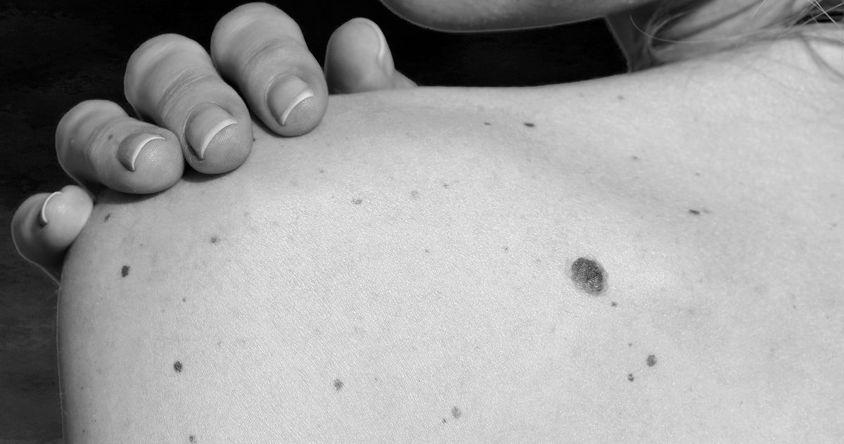 How Can I Tell If A Mole Is Cancerous?