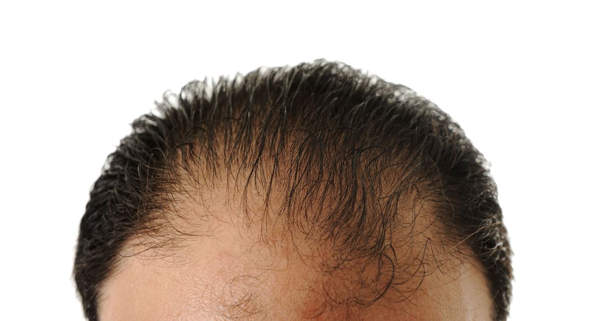 Foreskin May Help Cure Male-Pattern Baldness