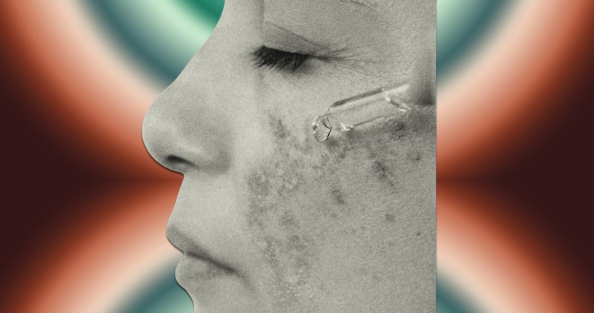 Now Is a Good Time to Start Your Melasma Routine