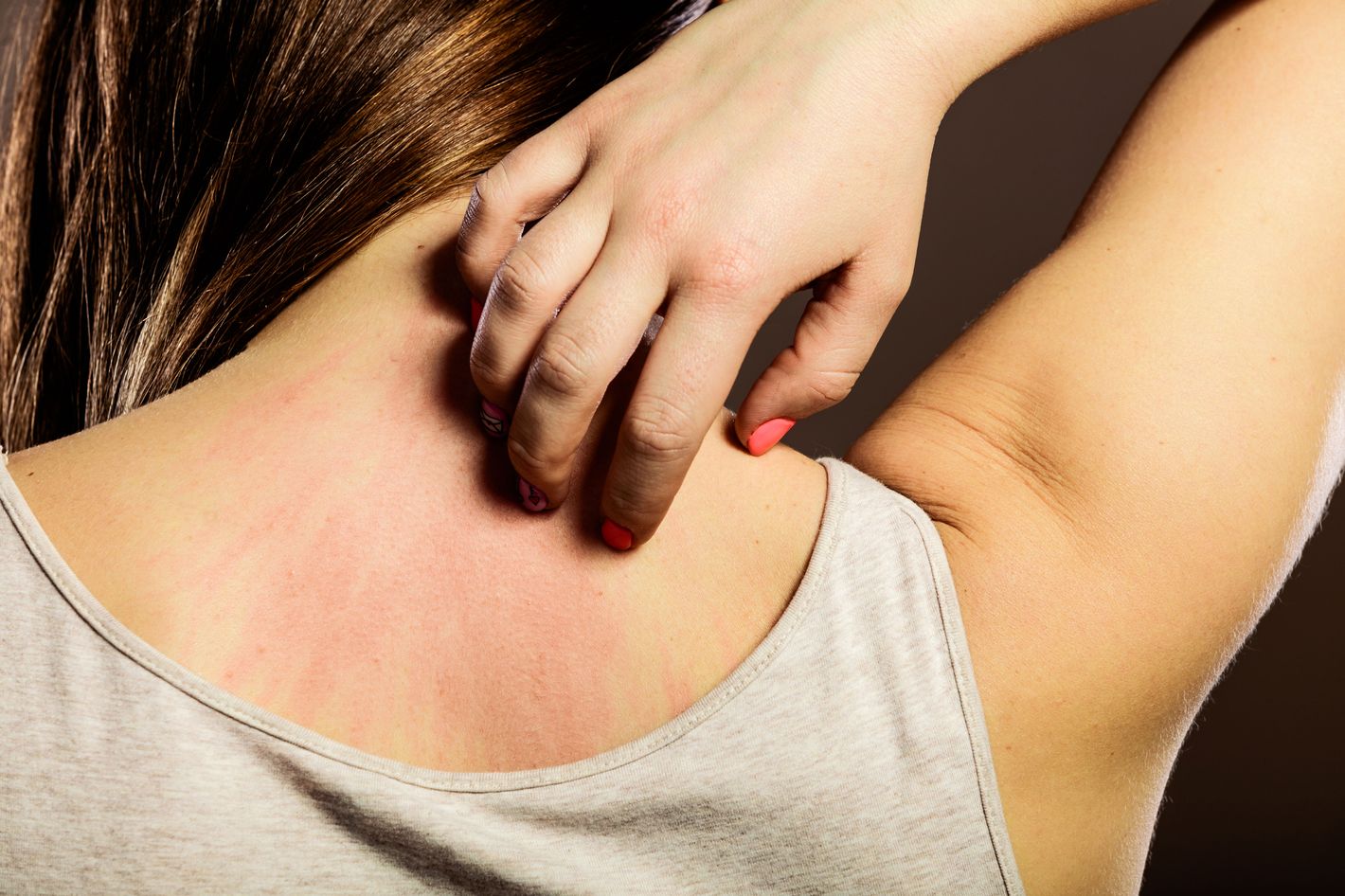 What Causes Hives