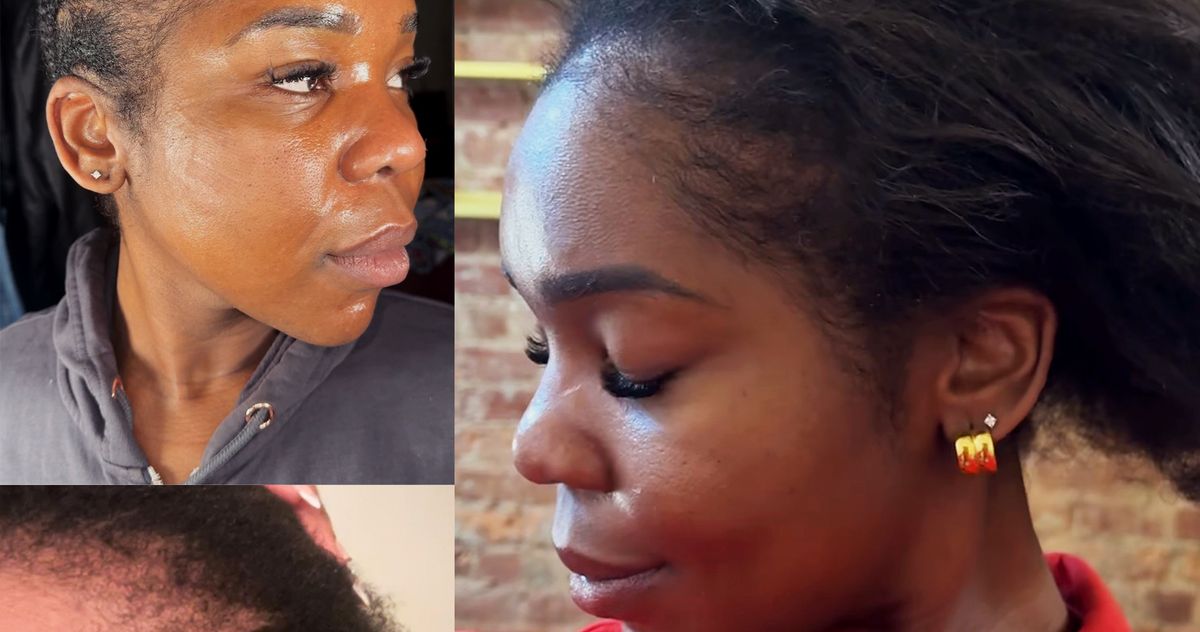 How a Nurse Practitioner Fixed Her Thinning Edges
