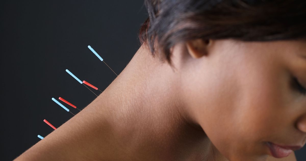 Acupuncture May Help Treat Migraines, a New Study Found Science of Us