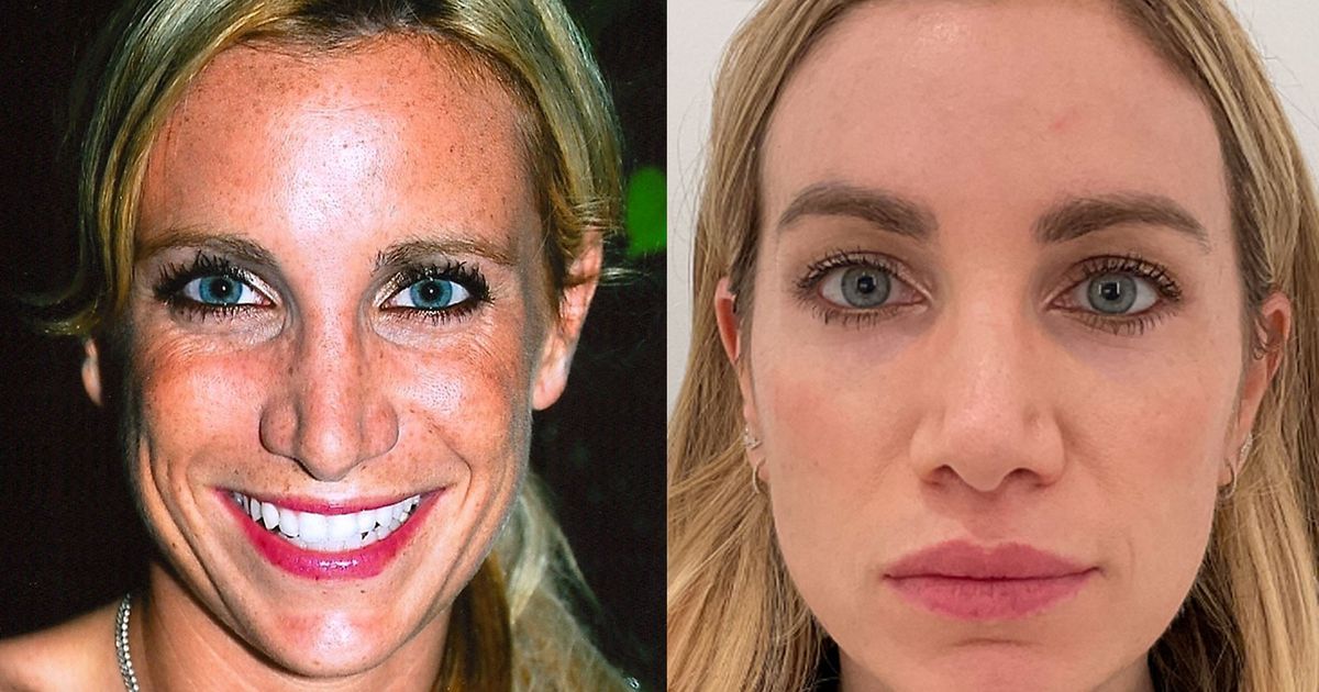 A Decade-Long Journey to Fix Sun Spots - The Cut