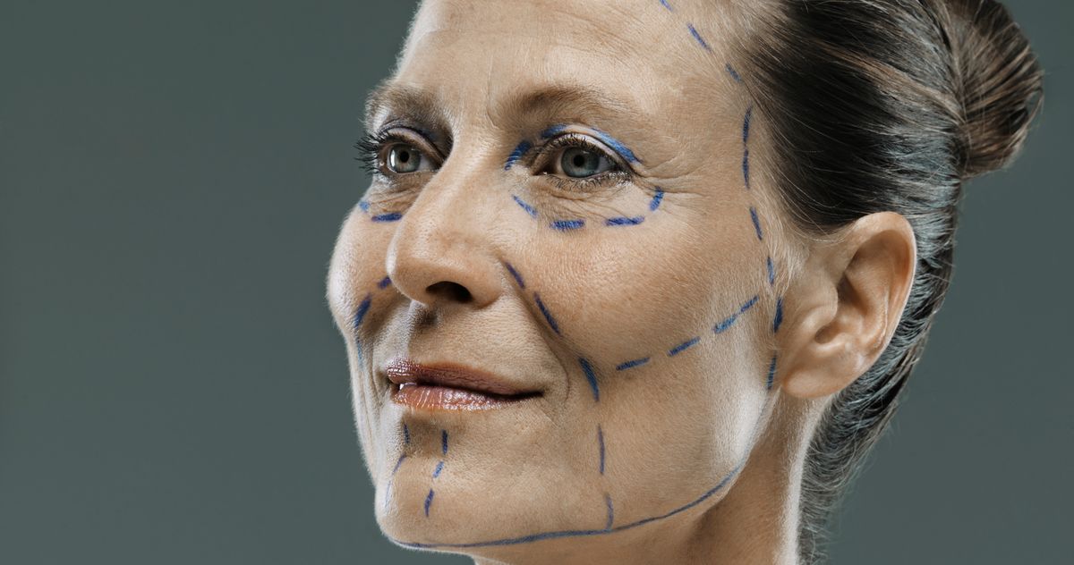 What Even Is a Deep-Plane Facelift?
