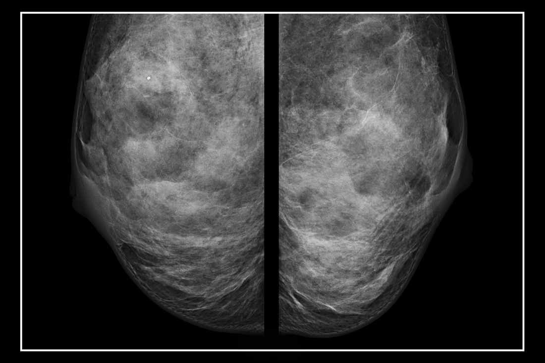 When a Mammogram Misses Breast Most cancers