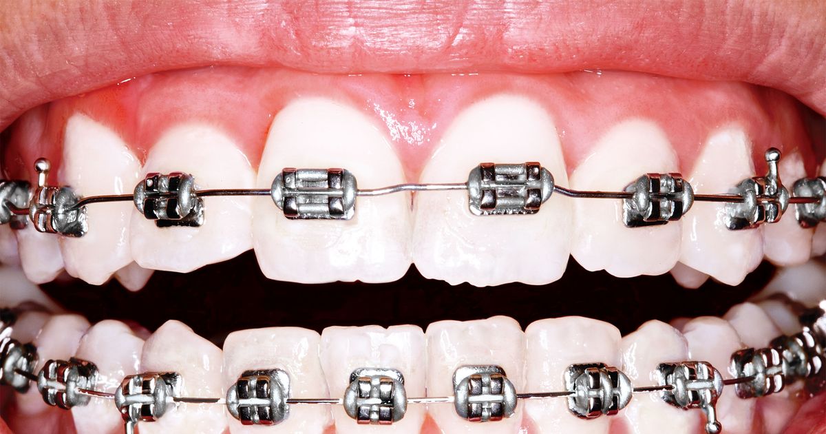 Braces Cost in Canada and Orthodontic Insurance [Explained