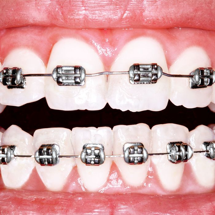 Why Is America Obsessed With Perfect Teeth?