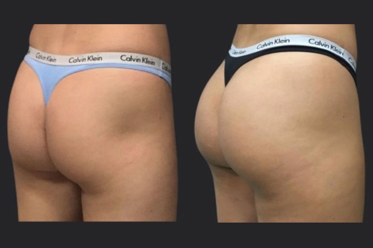 Brazilian big butt